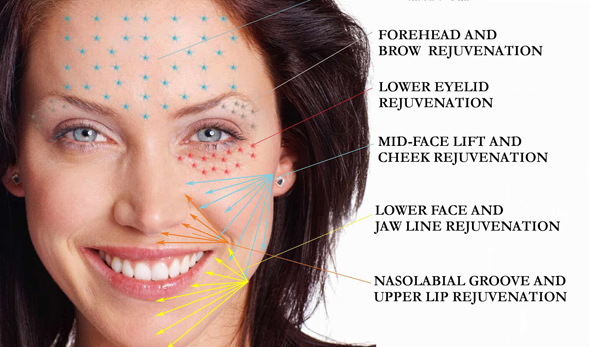 Acne scarring